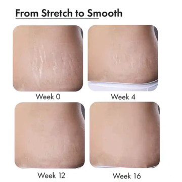 Ciara Liquid Serum for Stretch Marks | 6X Hyaluronic Acid + Squalane + Collagen | Fades Stretch Marks, Boosts Elasticity & Deep Skin Repair
