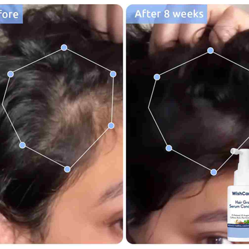 WishCare Hair Growth Serum Concentrate | 3% Redensyl + 4% Anagain + 2% Baicapil + Caffeine, Biotin, Rosemary & Rice Water | Clinically Proven to Boost Hair Growth & Reduce Hair Fall